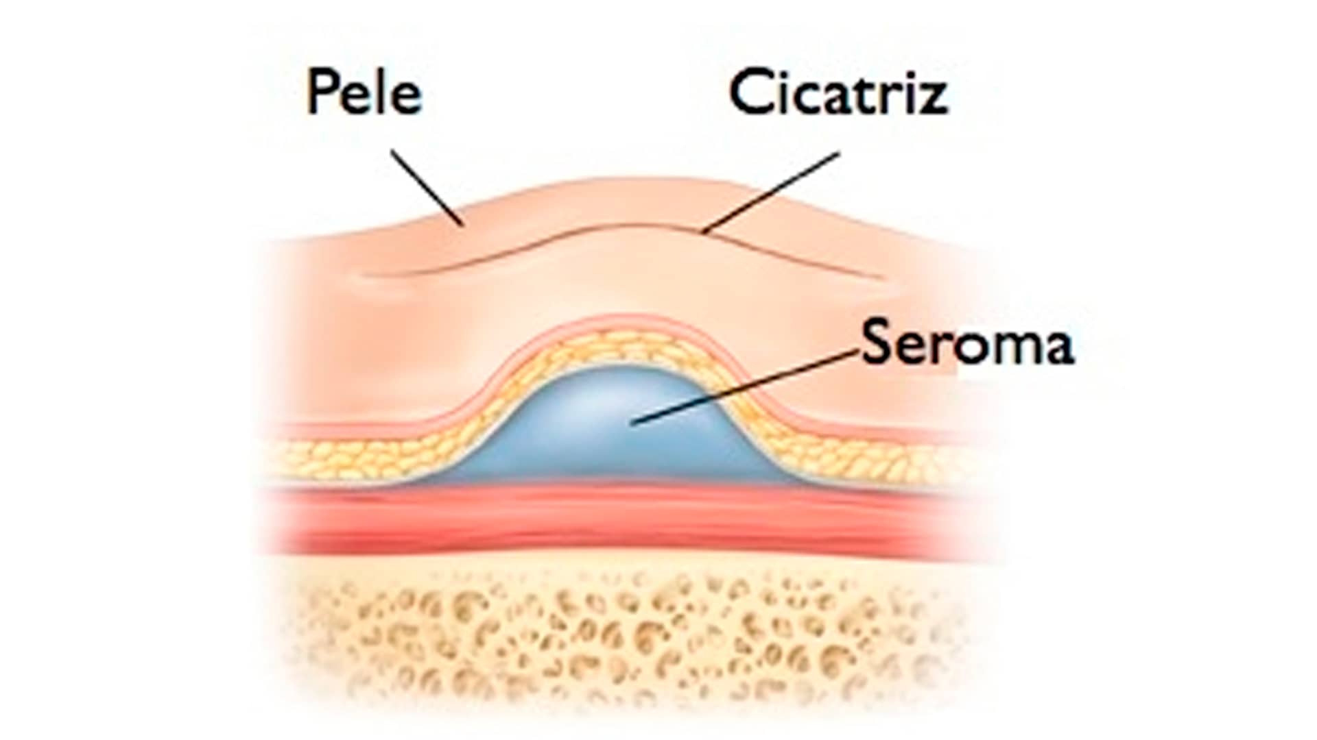 Workshop grabado - SEROMA: ¿CÓMO LO TRATO?