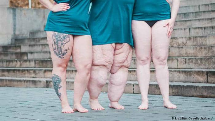 Workshop registrato - FISIOTERAPIA DERMATOFUNZIONALE NEL LIPEDEMA