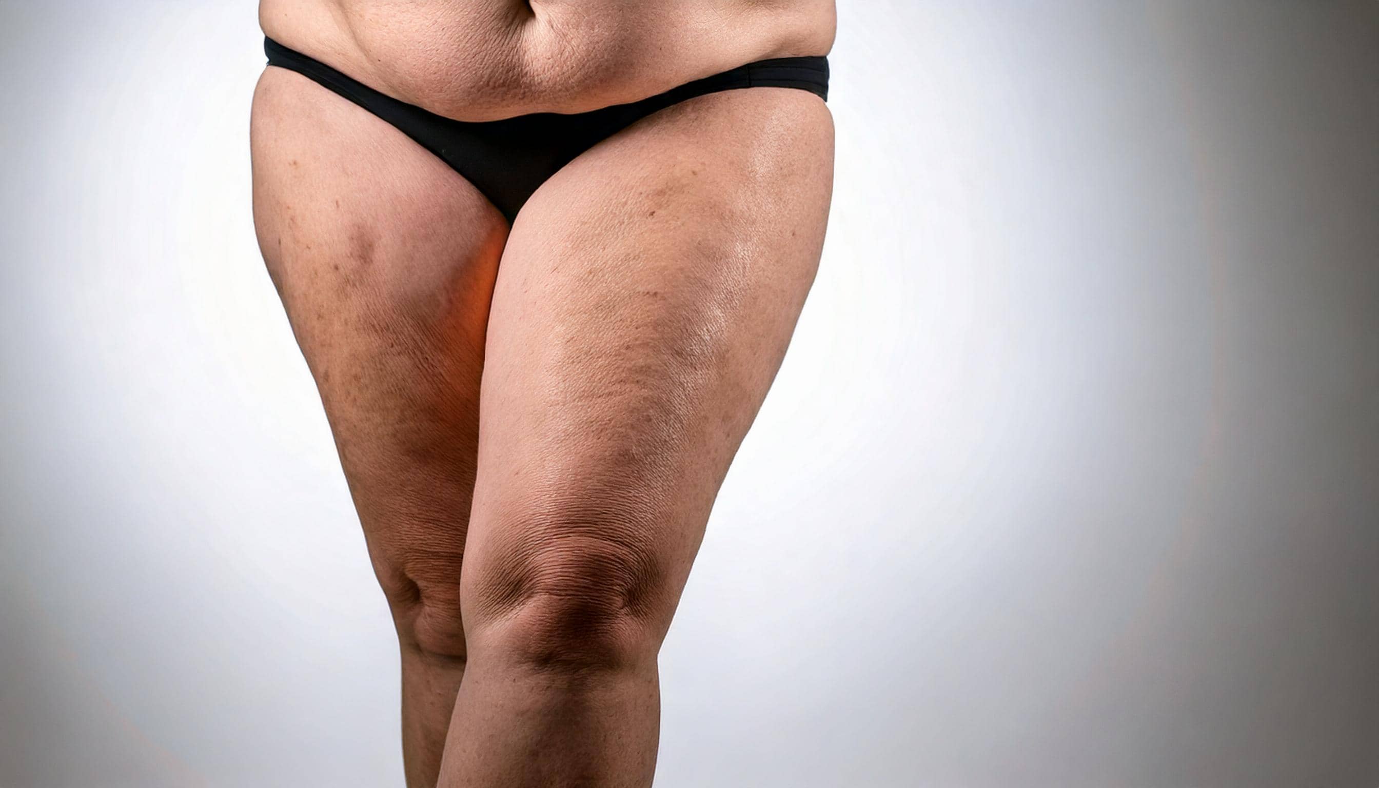 Curso gravado - ATUAÇÃO EM LIPEDEMA: DO DIAGNÓSTICO AO TRATAMENTO